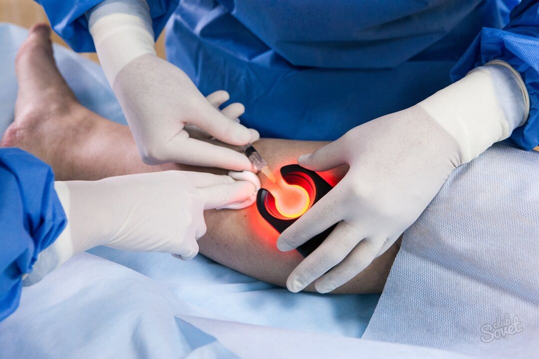 Varikozas vēnas uz kājām diagnostika