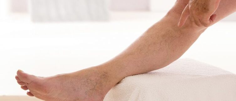 Varikozas vēnas uz kājām