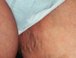 Varikozas iegurņa vēnas